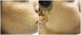 Get Microneedling Treatment in Honolulu  Hawaii
