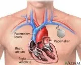 Find Pacemaker Surgery Cost at Top Hospital in Delhi - Crediheal