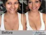 Lipoma Treatment in Homeopathy