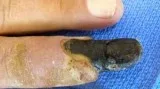 Best Gangrene Treatment In Jaipur