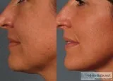 Vitality Spa Skin tightening treatment Boca Raton