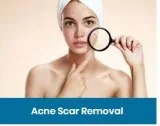 we treat major acne scar problems in hyderabad