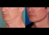 Best neck lift surgeon Miami - Dr. Ramirez Plastic Surgeon