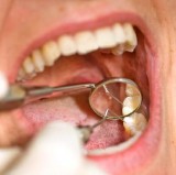 Root Canal Treatment Gilbert AZ- SofTouch Dental Care