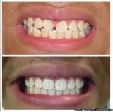 Invisalign Park Ridge IL  Loukas Denistry