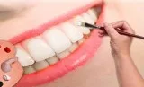Dental fillings in College Station  Medicaid accepted in Bryan