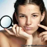 Acne Treatment in Gurgaon