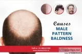 Are You Facing Baldness Get The Best Treatment for This Concern 