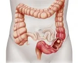 Signs Symptoms and Precautions for piles