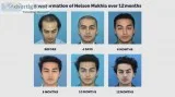 Hair Transplant in Mumbai