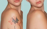 Spot and Tattoo Removal