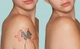 Spot and Tattoo Removal