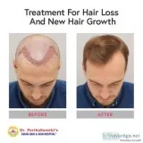 Best Hair Transplant Clinic in Bangalore