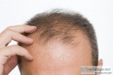 Reasons for hair loss in women
