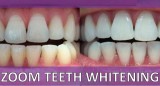 An Overview of Teeth Whitening Treatments and the Choices to Mak
