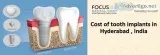 Dental Implants Clinic in Madinaguda(Miyapur)