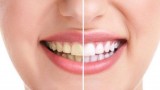 Best Teeth Whitening Clinic In Gurgaon - Punyam Dental