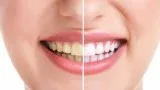 Best Teeth Whitening Clinic In Gurgaon - Punyam Dental