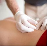 Dry needling Dublin an Alternate Treatment Procedure