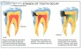 Root Canal Treatment in Gurgaon