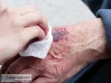 Non-Healing Wounds Treatment