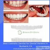 Best Porcelain Dental Veneers Burbank California