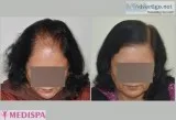 Get the best Female Hair Transplant in India at Medispa by Dr. S