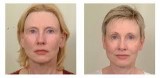 Blepharoplasty in Kansas  Kansas Plastic Surgery