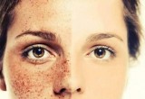 dark spot treatment in Kolkata