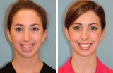 Orthognathic Surgery Treatment at Smile Stylers