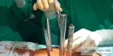 Spine Surgery - Neuro Life Hospital