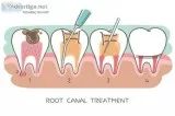 Get available one of the best Root Canal Specialist in south Kol