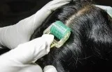 hair fall treatment in chennai