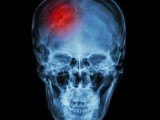 Neurologist  Brooklyn NY  Strokeclinicsofnyc.c om