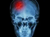 Neurologist  Brooklyn NY  Strokeclinicsofnyc.c om