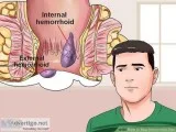 Piles Surgeon in Delhi  Dr. SK Biswas   919718786512