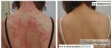 BEST TREATMENT FOR PSORIASIS