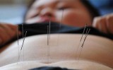 Weight Loss Acupuncture