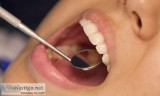 Dental Veneers in CT