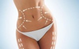 Want the Results of Liposuction Without the Surgery in Toronto 