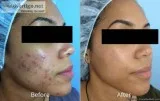 Berkowits Hydra Facial Treatment in Delhi