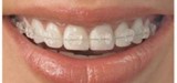 Dental braces in Mohali  Orthodontic dentist in Mohali  Dentia  