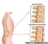 Homeopathic Medicines for Ankylosing Spondylitis Treatment