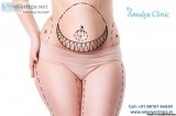 Tummy Tuck Surgery For A Sculpted and Toned Stomach