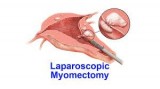 Laparoscopic or Robotic Myomectomy Treatment specialists in Vash