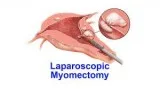 Laparoscopic or Robotic Myomectomy Treatment specialists in Vash
