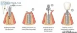 Dental Implants Treatment in Australia