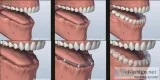 Replace Missing Tooth  Sunset Periodontics