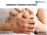 6th best homeopathy medicines for  Eczema