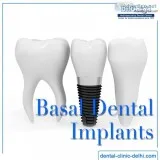 Basal Dental Implants in India